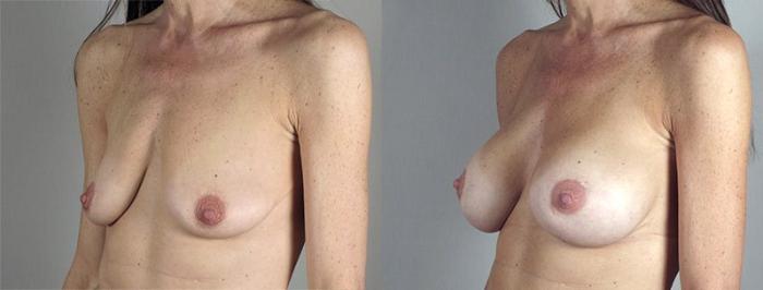 Breast Augmentation Case 346 Before & After View #2 | Paramus, New Jersey | Parker Center for Plastic Surgery