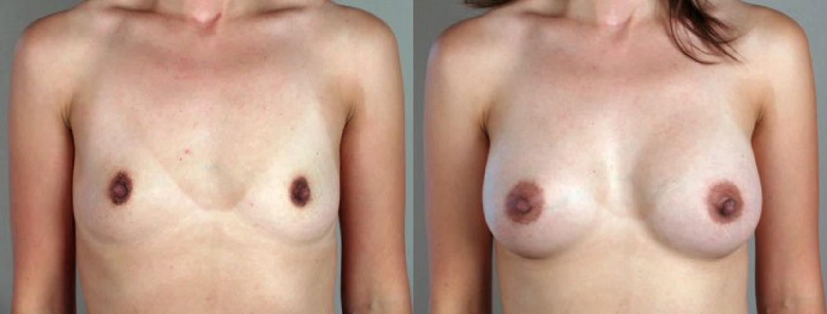 Breast Augmentation Case 347 Before & After View #1 | Paramus, New Jersey | Parker Center for Plastic Surgery