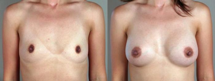 Breast Augmentation Case 347 Before & After View #1 | Paramus, New Jersey | Parker Center for Plastic Surgery