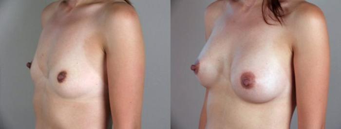 Breast Augmentation Case 347 Before & After View #2 | Paramus, New Jersey | Parker Center for Plastic Surgery
