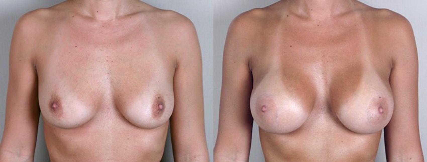Breast Augmentation Case 348 Before & After View #1 | Paramus, New Jersey | Parker Center for Plastic Surgery