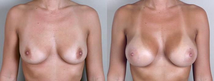 Breast Augmentation Case 348 Before & After View #1 | Paramus, New Jersey | Parker Center for Plastic Surgery