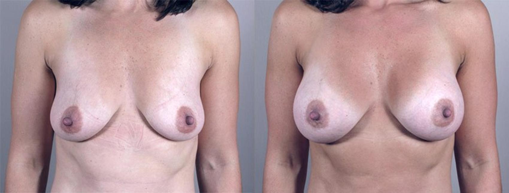 Breast Augmentation Case 349 Before & After View #1 | Paramus, New Jersey | Parker Center for Plastic Surgery