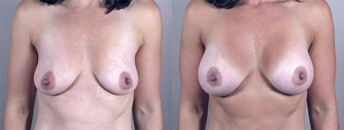 Breast Augmentation Case 349 Before & After View #1 | Paramus, New Jersey | Parker Center for Plastic Surgery