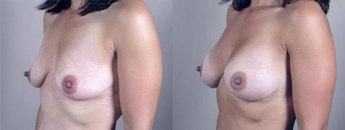 Breast Augmentation Case 349 Before & After View #2 | Paramus, New Jersey | Parker Center for Plastic Surgery