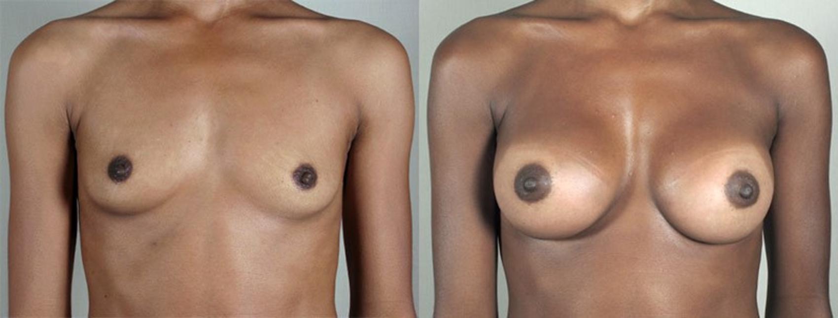 Breast Augmentation Case 350 Before & After View #1 | Paramus, New Jersey | Parker Center for Plastic Surgery