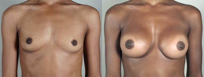 Breast Augmentation Case 350 Before & After View #1 | Paramus, New Jersey | Parker Center for Plastic Surgery