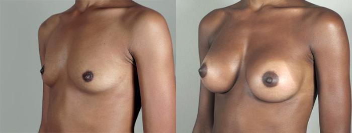 Breast Augmentation Case 350 Before & After View #2 | Paramus, New Jersey | Parker Center for Plastic Surgery