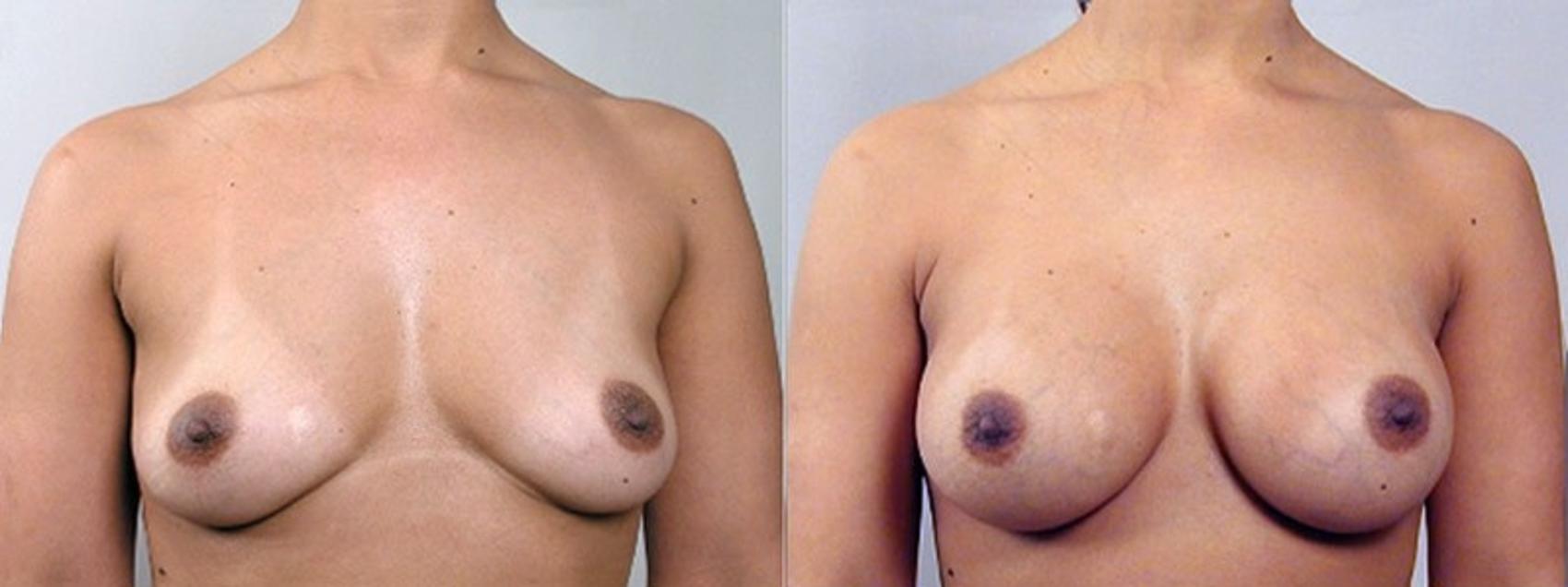 Breast Augmentation Case 351 Before & After View #1 | Paramus, New Jersey | Parker Center for Plastic Surgery