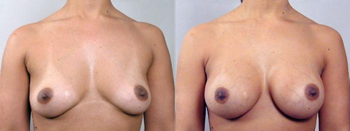 Breast Augmentation Case 351 Before & After View #1 | Paramus, New Jersey | Parker Center for Plastic Surgery