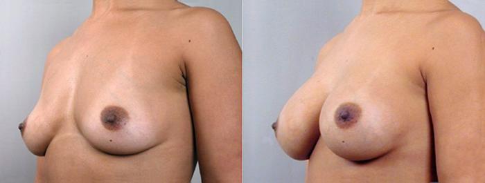Breast Augmentation Case 351 Before & After View #2 | Paramus, New Jersey | Parker Center for Plastic Surgery