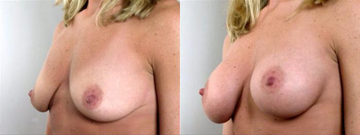 Breast Augmentation Case 352 Before & After View #2 | Paramus, New Jersey | Parker Center for Plastic Surgery