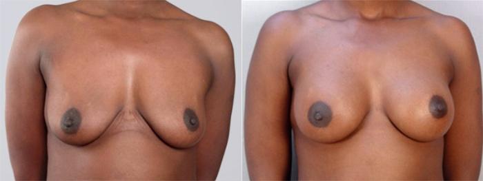 Breast Augmentation Case 353 Before & After View #1 | Paramus, New Jersey | Parker Center for Plastic Surgery