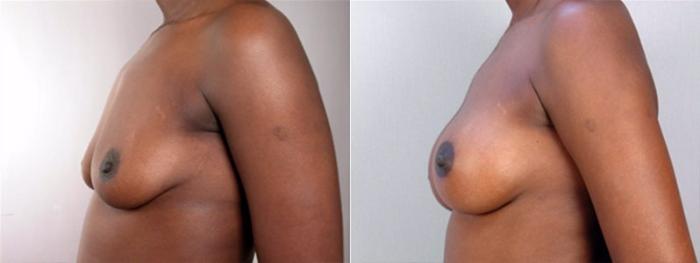 Breast Augmentation Case 353 Before & After View #2 | Paramus, New Jersey | Parker Center for Plastic Surgery