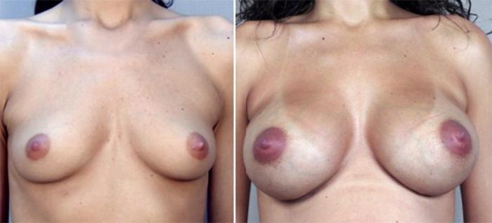 Breast Augmentation Case 354 Before & After View #1 | Paramus, New Jersey | Parker Center for Plastic Surgery