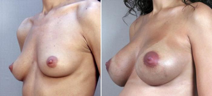 Breast Augmentation Case 354 Before & After View #2 | Paramus, New Jersey | Parker Center for Plastic Surgery