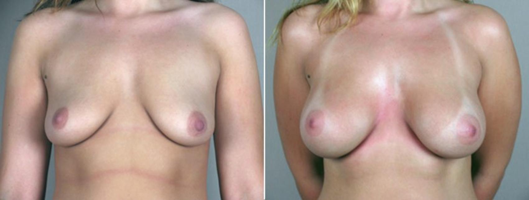 Breast Augmentation Case 355 Before & After View #1 | Paramus, New Jersey | Parker Center for Plastic Surgery
