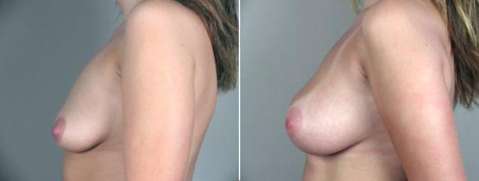 Breast Augmentation Case 355 Before & After View #2 | Paramus, New Jersey | Parker Center for Plastic Surgery