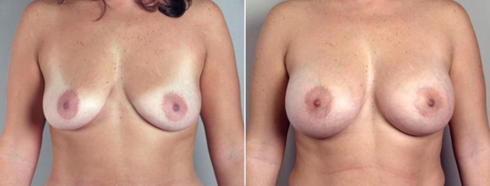 Breast Augmentation Case 356 Before & After View #1 | Paramus, New Jersey | Parker Center for Plastic Surgery