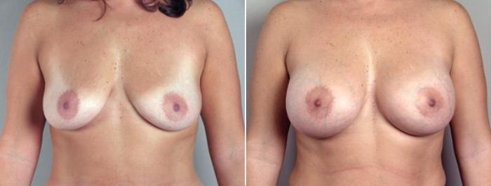 Breast Augmentation Case 356 Before & After View #1 | Paramus, New Jersey | Parker Center for Plastic Surgery