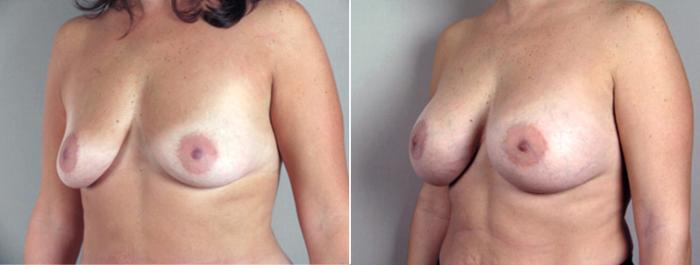 Breast Augmentation Case 356 Before & After View #2 | Paramus, New Jersey | Parker Center for Plastic Surgery