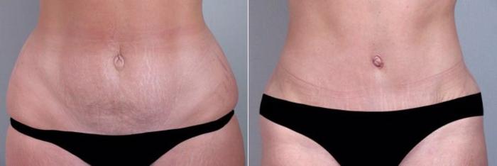 Breast Augmentation Case 356 Before & After View #3 | Paramus, New Jersey | Parker Center for Plastic Surgery