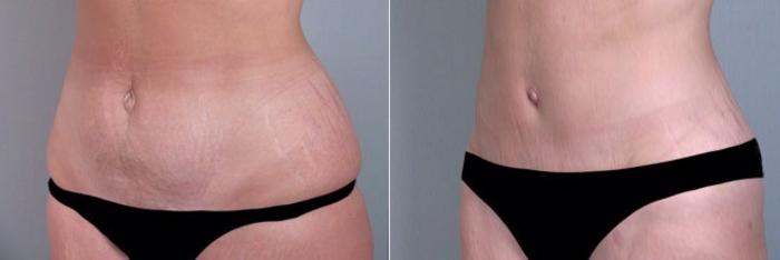 Breast Augmentation Case 356 Before & After View #4 | Paramus, New Jersey | Parker Center for Plastic Surgery