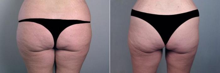 Breast Augmentation Case 356 Before & After View #5 | Paramus, New Jersey | Parker Center for Plastic Surgery