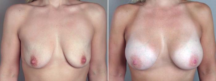 Breast Augmentation Case 357 Before & After View #1 | Paramus, New Jersey | Parker Center for Plastic Surgery