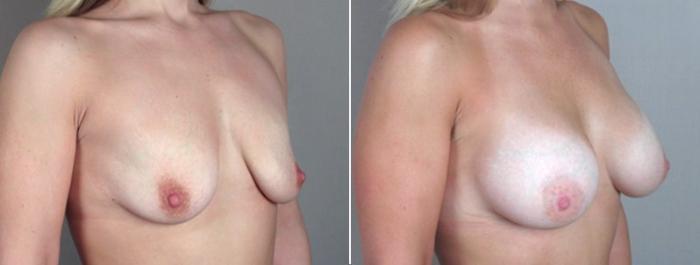 Breast Augmentation Case 357 Before & After View #2 | Paramus, New Jersey | Parker Center for Plastic Surgery