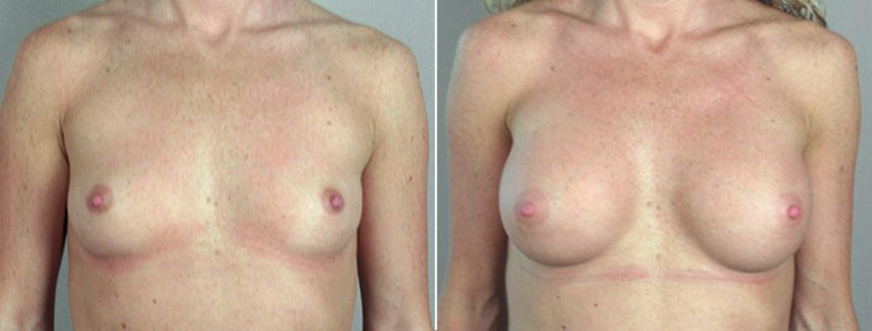 Breast Augmentation Case 358 Before & After View #1 | Paramus, New Jersey | Parker Center for Plastic Surgery
