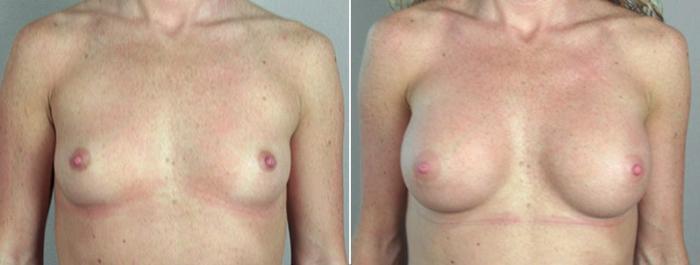 Breast Augmentation Case 358 Before & After View #1 | Paramus, New Jersey | Parker Center for Plastic Surgery