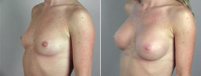 Breast Augmentation Case 358 Before & After View #2 | Paramus, New Jersey | Parker Center for Plastic Surgery