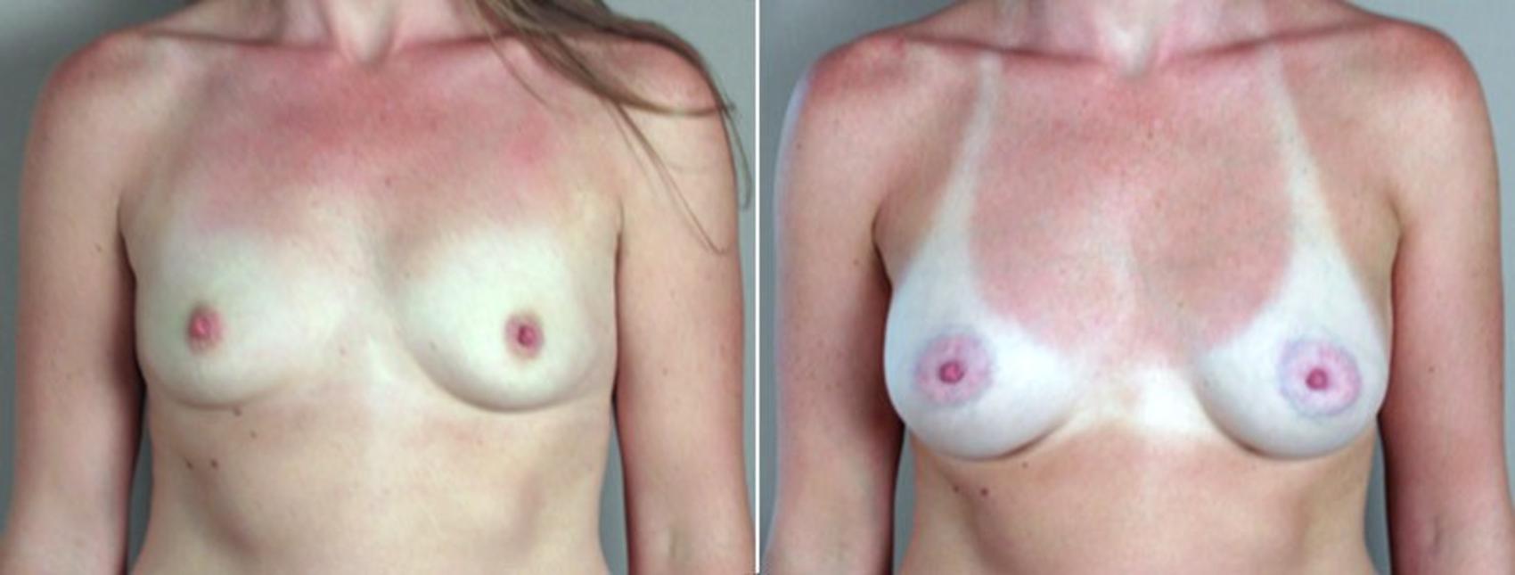 Breast Augmentation Case 359 Before & After View #1 | Paramus, New Jersey | Parker Center for Plastic Surgery