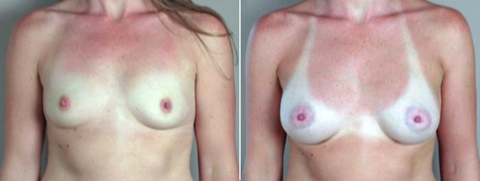 Breast Augmentation Case 359 Before & After View #1 | Paramus, New Jersey | Parker Center for Plastic Surgery