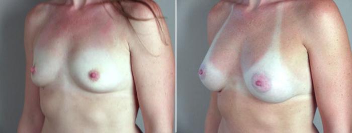 Breast Augmentation Case 359 Before & After View #2 | Paramus, New Jersey | Parker Center for Plastic Surgery