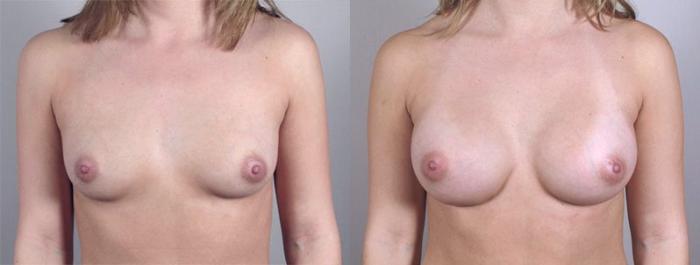Breast Augmentation Case 360 Before & After View #1 | Paramus, New Jersey | Parker Center for Plastic Surgery