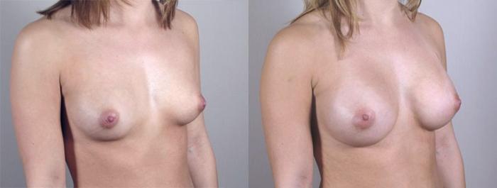 Breast Augmentation Case 360 Before & After View #2 | Paramus, New Jersey | Parker Center for Plastic Surgery