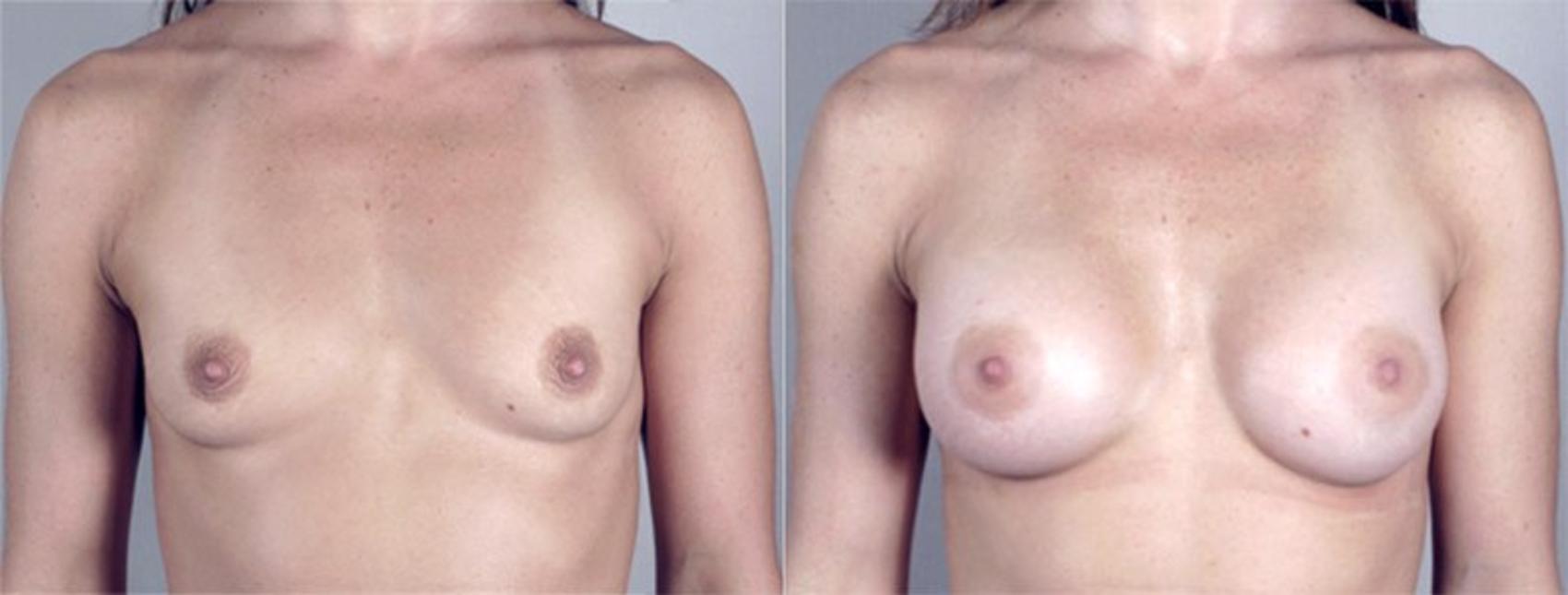 Breast Augmentation Case 361 Before & After View #1 | Paramus, New Jersey | Parker Center for Plastic Surgery