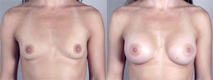 Breast Augmentation Case 361 Before & After View #1 | Paramus, New Jersey | Parker Center for Plastic Surgery