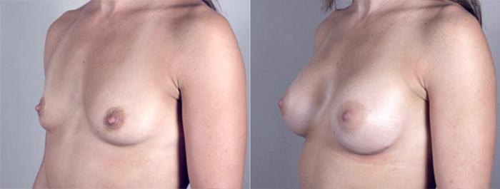 Breast Augmentation Case 361 Before & After View #2 | Paramus, New Jersey | Parker Center for Plastic Surgery