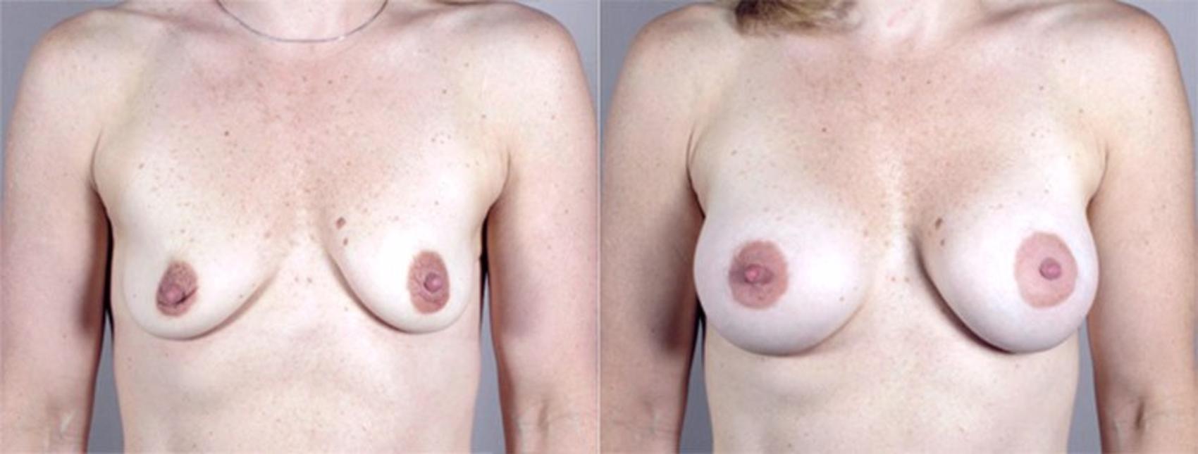 Breast Augmentation Case 362 Before & After View #1 | Paramus, New Jersey | Parker Center for Plastic Surgery