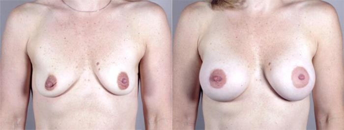 Breast Augmentation Case 362 Before & After View #1 | Paramus, New Jersey | Parker Center for Plastic Surgery