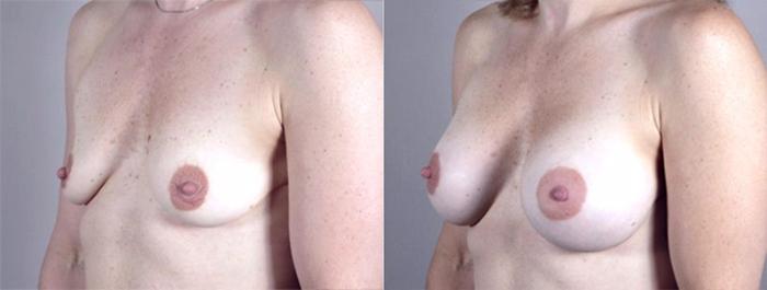 Breast Augmentation Case 362 Before & After View #2 | Paramus, New Jersey | Parker Center for Plastic Surgery