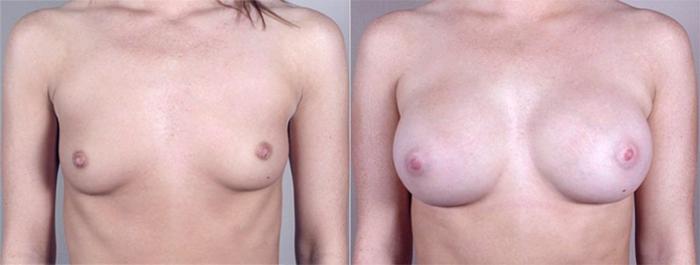 Breast Augmentation Case 364 Before & After View #1 | Paramus, New Jersey | Parker Center for Plastic Surgery