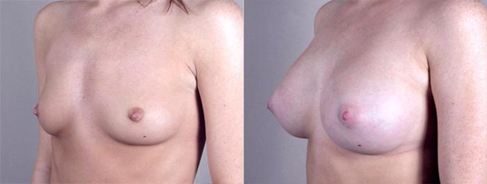 Breast Augmentation Case 364 Before & After View #2 | Paramus, New Jersey | Parker Center for Plastic Surgery