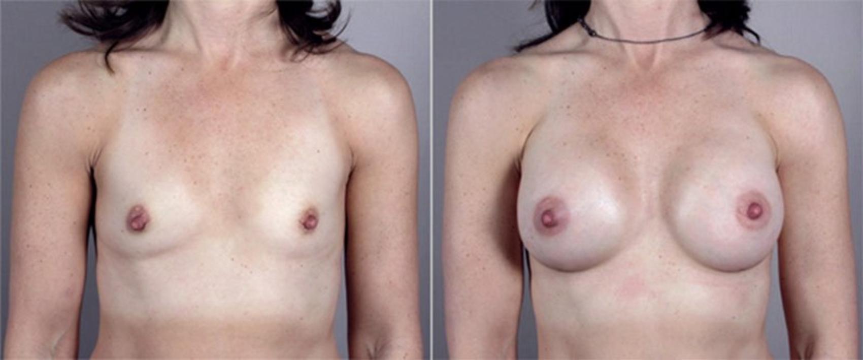 Breast Augmentation Case 365 Before & After View #1 | Paramus, New Jersey | Parker Center for Plastic Surgery