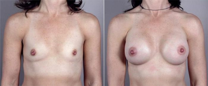 Breast Augmentation Case 365 Before & After View #1 | Paramus, New Jersey | Parker Center for Plastic Surgery