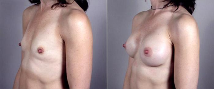 Breast Augmentation Case 365 Before & After View #2 | Paramus, New Jersey | Parker Center for Plastic Surgery