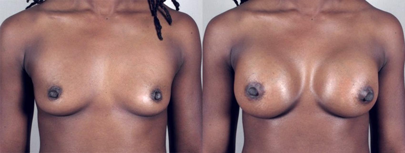 Breast Augmentation Case 366 Before & After View #1 | Paramus, New Jersey | Parker Center for Plastic Surgery